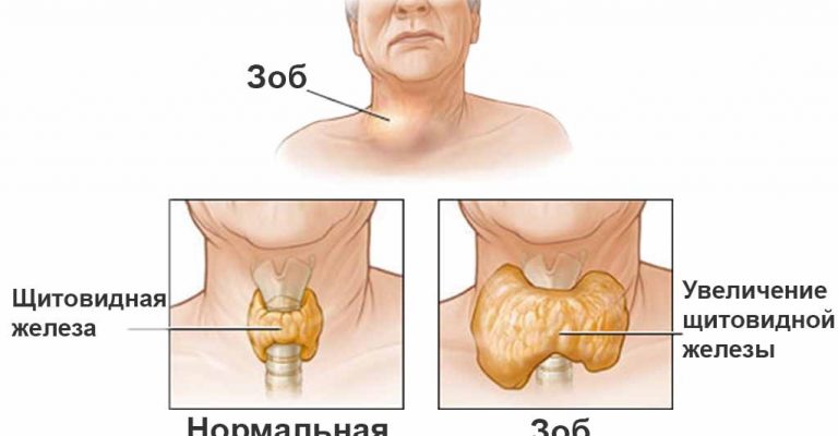 Заболевания Щитовидной Железы У Детей Реферат
